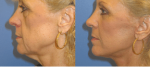 Diamond Facelift Patient Before and After photos