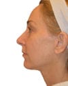 Facelift Patient 10 - After - 1 thumbnail