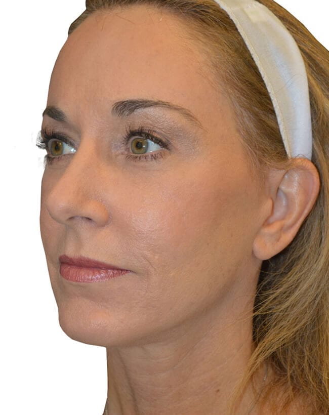 Facelift Patient 10 - After - 1