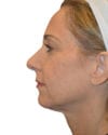 Facelift Patient 10 - Before - 1 thumbnail