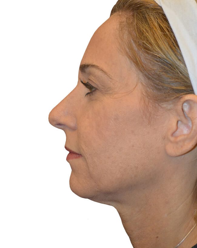 Facelift Patient 10 - Before - 2