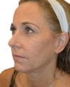 Facelift Patient 10 - Before - 1 thumbnail