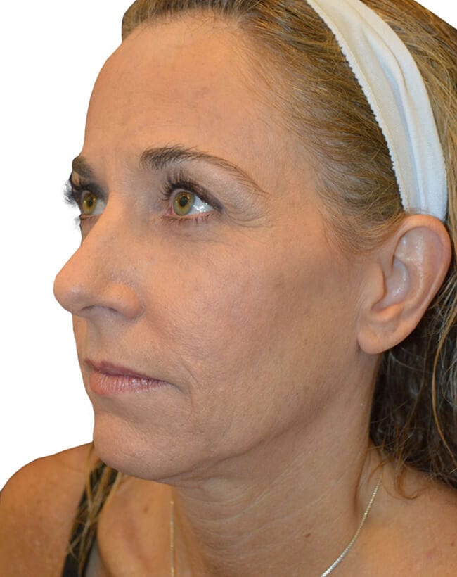Facelift Patient 10 - Before - 1