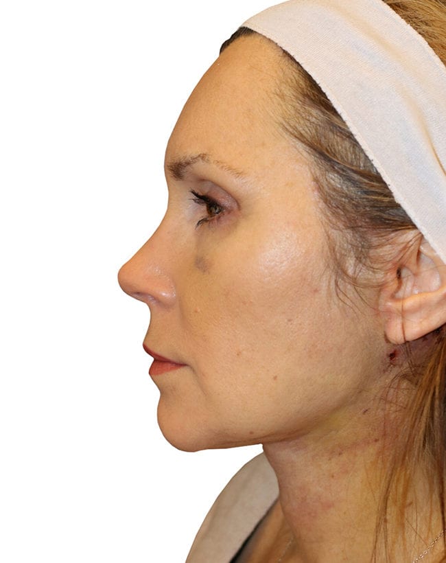 Facelift Patient 09 - After - 1
