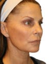 Facelift Patient 03 - After - 1 thumbnail