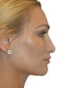 Rhinoplasty Patient 11 - Before - 1 thumbnail