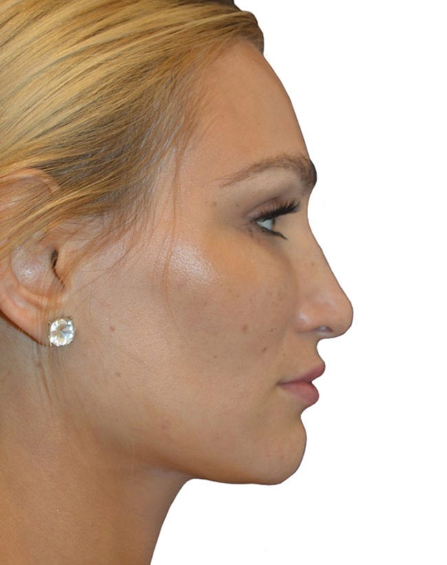 Rhinoplasty Patient 11 - Before - 1
