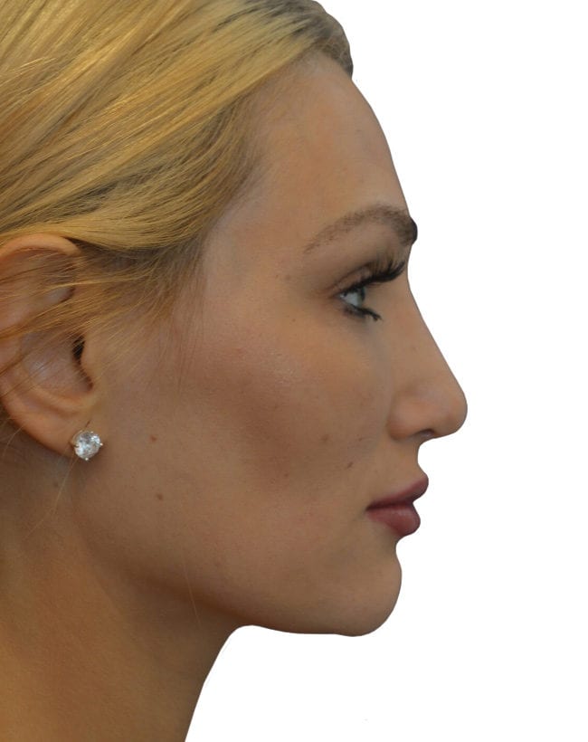 Rhinoplasty Patient 11 - After - 1