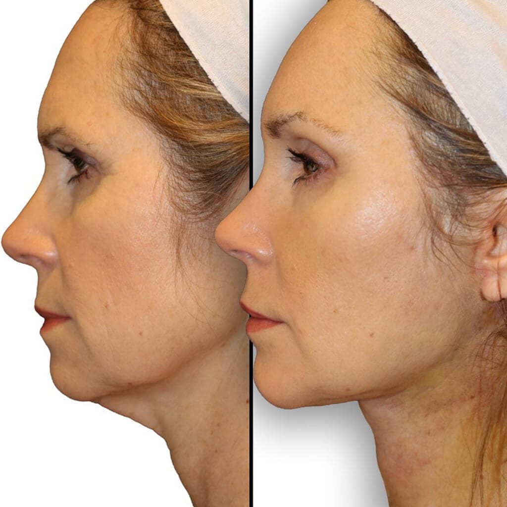 Facelift Procedures