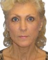 Brow Lift Patient 05 - After - 1 thumbnail
