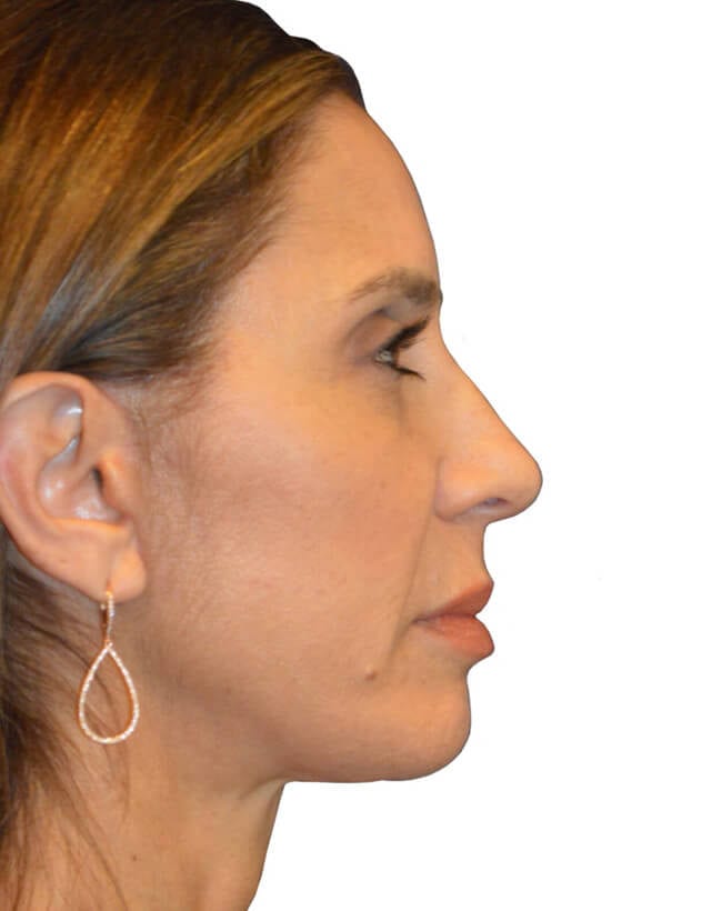 Brow Lift Patient 04 - After - 1