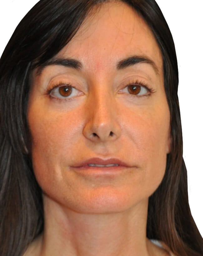 Brow Lift Patient 03 - After - 1