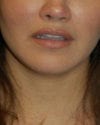 Lip Augmentation Patient 03 - After - 1 thumbnail
