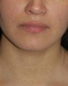 Lip Augmentation Patient 03 - Before - 1 thumbnail