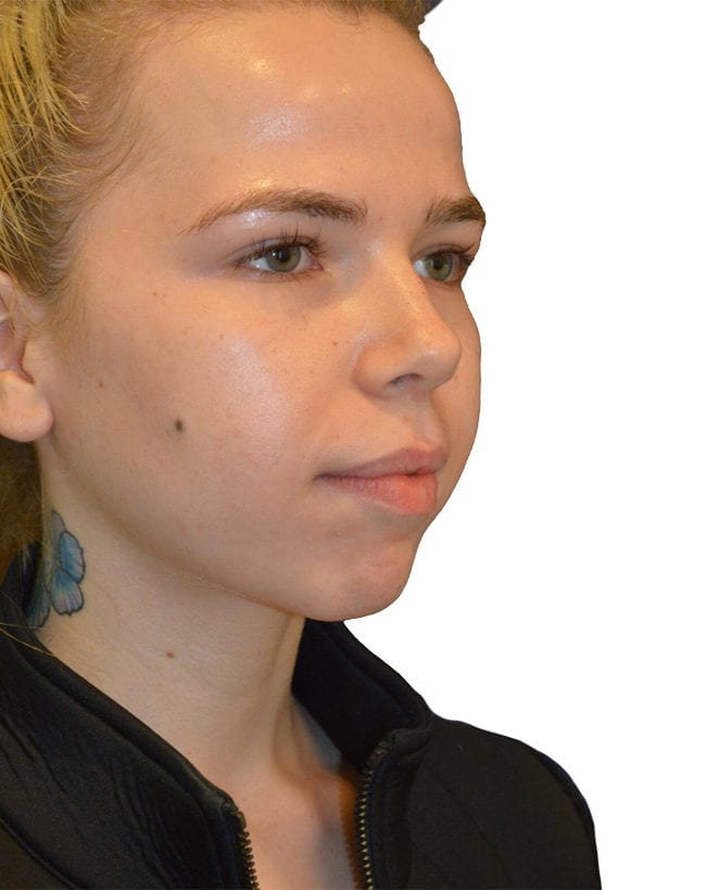 The Diamond Facial Sculpting Patient 18 - Before - 2