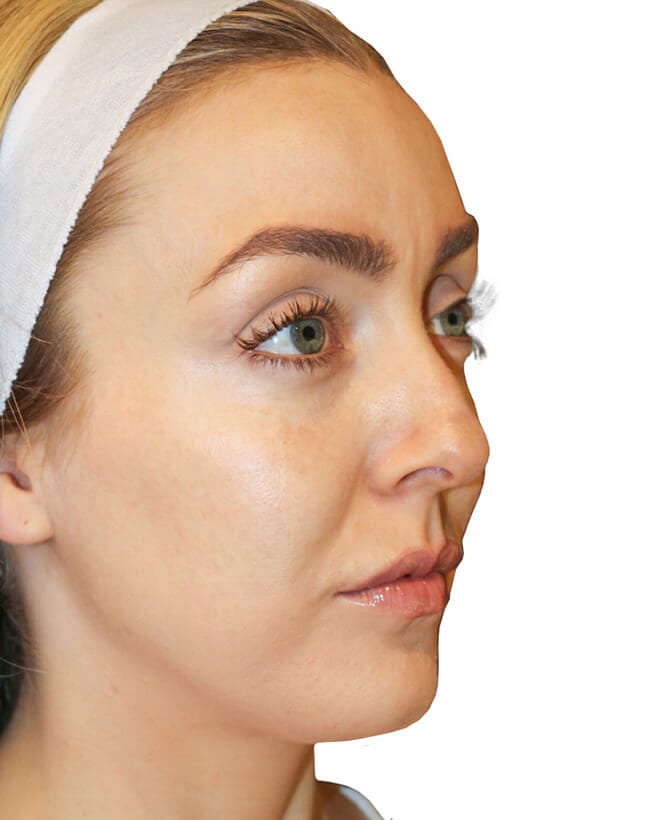 The Diamond Facial Sculpting Patient 17 - Before - 2