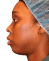 The Diamond Facial Sculpting Patient 15 - Before - 1 thumbnail