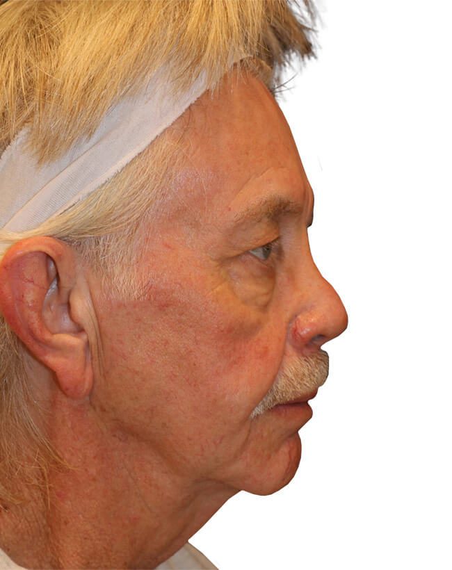 Facelift Patient 19 - Before - 4