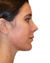 The Diamond Facial Sculpting Patient 24 - After - 1 thumbnail